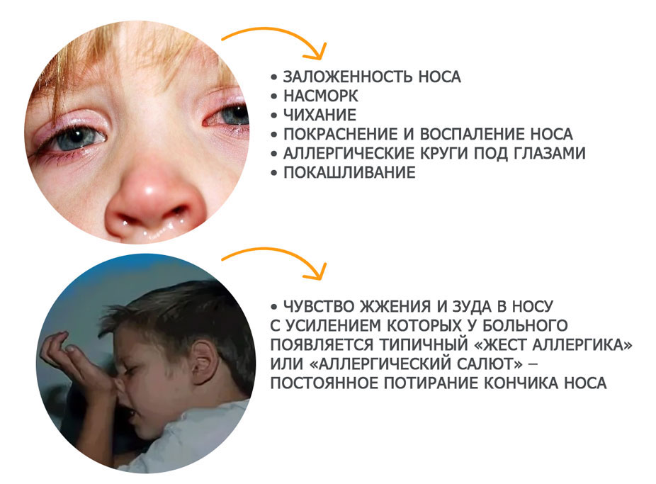 riski allergicheskih reaktsiy u detey rol sintetiki v odezhde