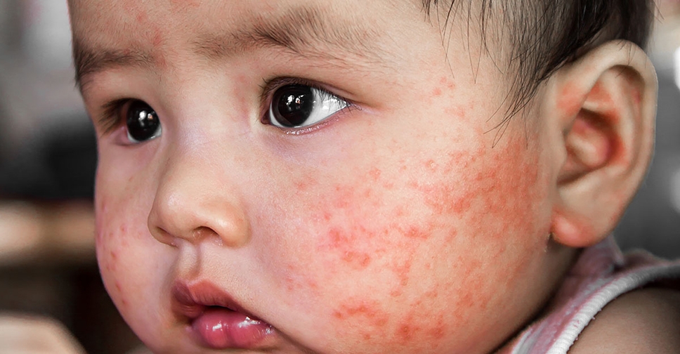 uhod za kozhey mladentsa s atopicheskim dermatitom